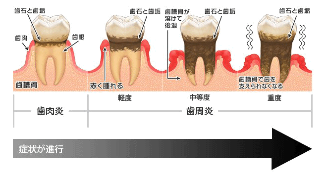 歯周病