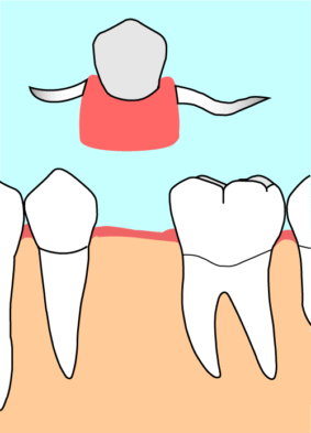 部分入れ歯