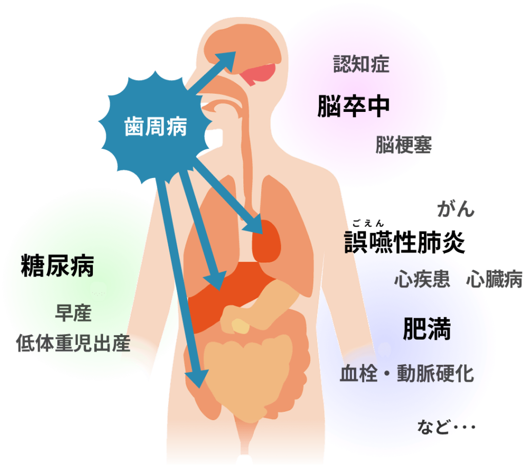 歯周病がもたらす全身疾患